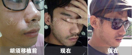 碧莲盛胡须移植大概多少钱