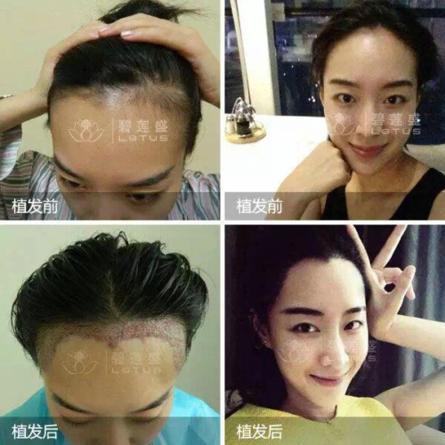 如何判断发际线偏高该怎么改善
