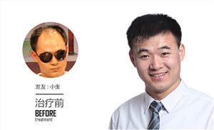 男士发际线两边高,植发发际线能改善吗