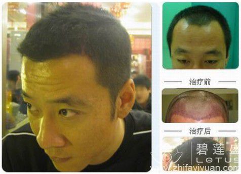 <em>头发移植</em>效果怎么样好吗 <em>头发移植</em>效果可以维
