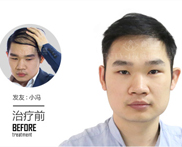 有哪些好的治疗脱发的方法