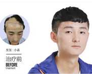 为什么人会一直不停的掉头发