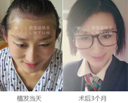 前面不长头发怎么办
