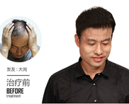 男性脱发用生姜擦头皮有用么怎么样