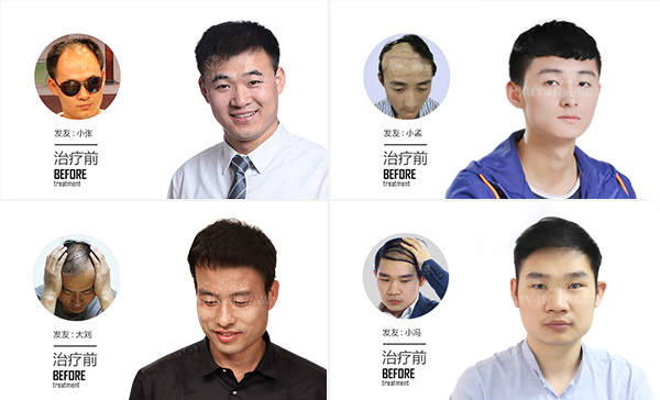 为什么治疗脱发的特效药非那雄胺没有普及?