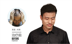 m型发际线植发前需要做哪些检测