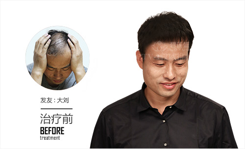 疤痕脱发能被治好吗-碧莲盛植发医院
