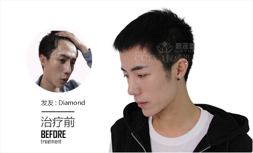 头上刀疤导致的脱发能治疗吗-碧莲盛植发医院