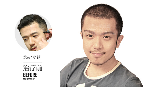 两边的鬓角都能种植吗