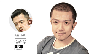 男性怎么看待鬓角种植效果