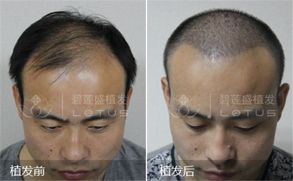 前后对比图111.jpg