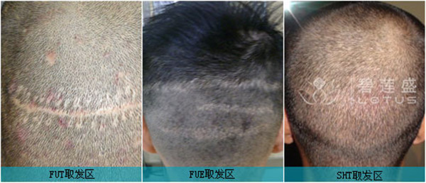 FUT、FUE、SHT对比.jpg