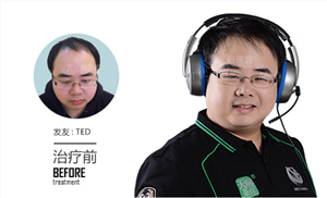做头发移植的价格是多少