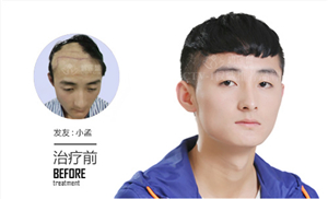 碧莲盛植发手术安全吗