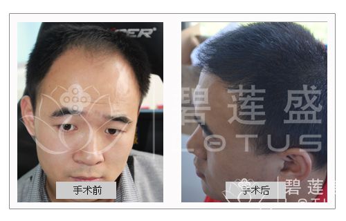 毛发<em>移植</em>后<em>多久</em>长<em>头发</em> 毛发<em>移植</em>后<em>多久</em>见效果