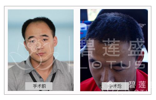 毛发<em>种植</em>的不良<em>后果</em> <em>种植头发</em>效果怎么样 - 碧