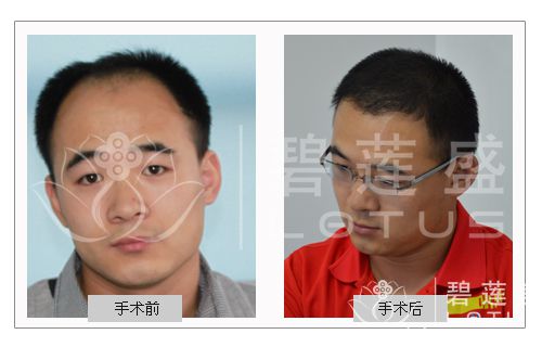 <em>种植头发</em>疼不疼 - 碧莲盛无痕植发最好的医院