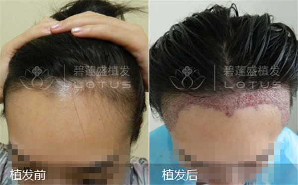 请问毛发移植手术要多少费用