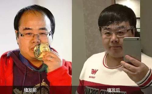 做毛发种植手术的费用能分期付吗?-碧莲盛植发