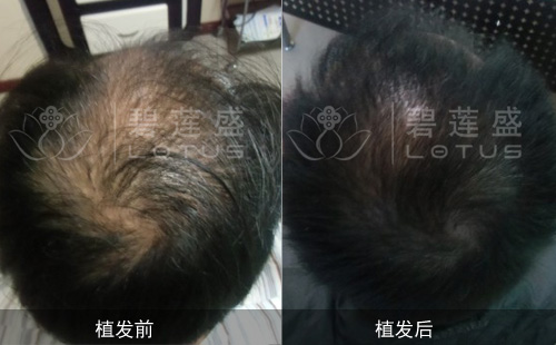 南京碧莲盛种植毛发需要种多少毛囊