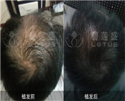 ted种植头发花了多少钱