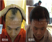 大连种植眉毛怎么收费
