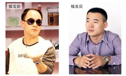 fut头发移植成活率高吗 fut头发移植效果如何 -