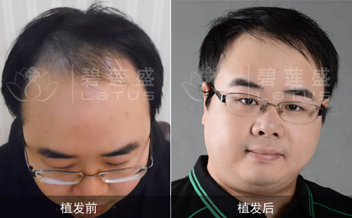 有什么办法可以治<em>脱头发</em> - 碧莲盛无痕植发<em>最好</em>