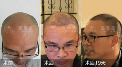 前额m型脱发能治愈不
