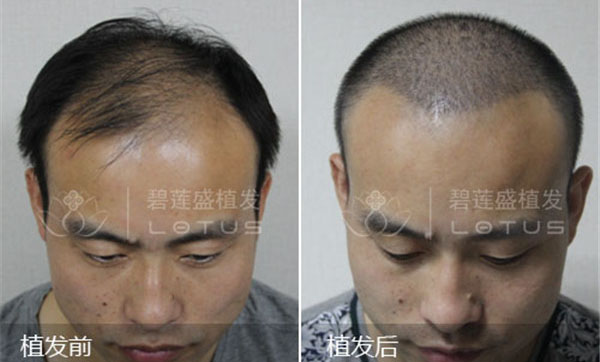 脂溢性脱发是怎么回事?脂溢性脱发应该如何治疗?