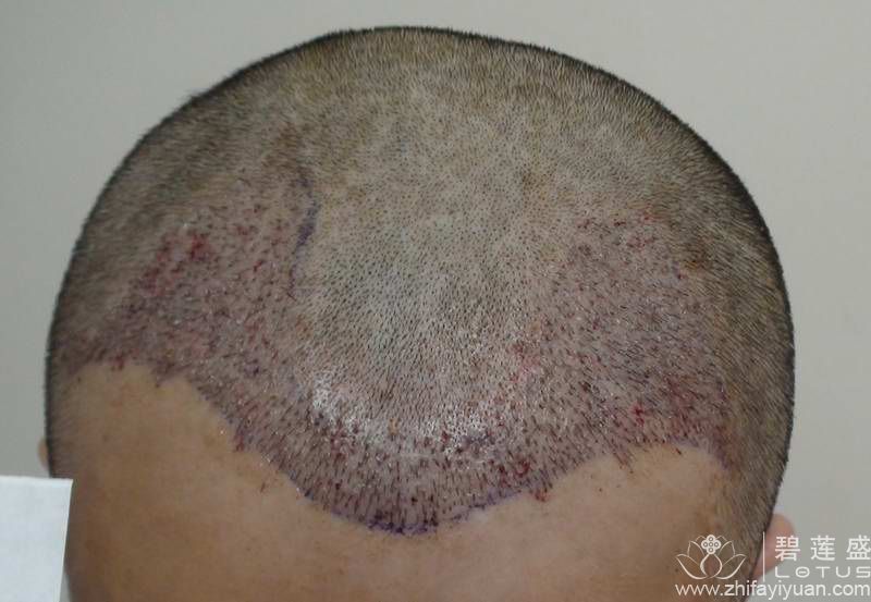 前额没有头发的治疗方法有哪些 - 碧莲盛无痕植