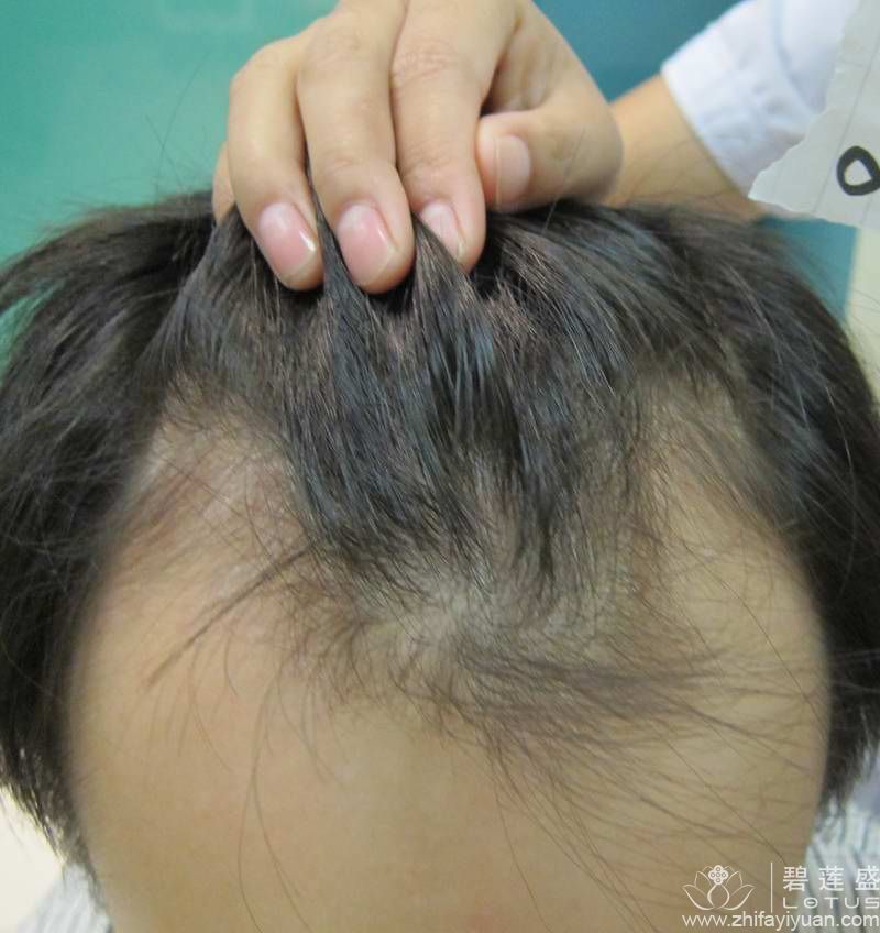 前额没有头发的治疗方法有哪些 - 碧莲盛无痕植