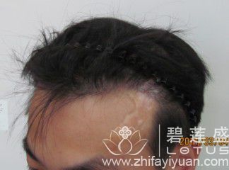 头皮疤<em>移植</em>有效果吗 头皮<em>疤痕</em>能毛发<em>移植</em>吗 - 