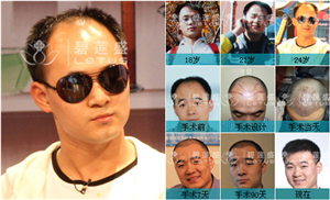 <em>头发移植后注意事项</em>全面讲解 - 碧莲盛无痕植发