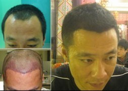 植手术,<em>头发移植</em>多少钱,<em>头发移植需要多少钱</em> -