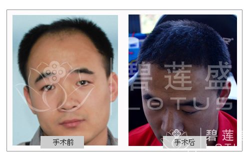 <em>头发移植</em>有<em>坏处</em>吗 - 碧莲盛无痕植发最好的医院