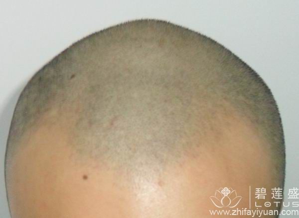 <em>前额头发稀疏</em>怎么办 - 碧莲盛无痕植发最好的医