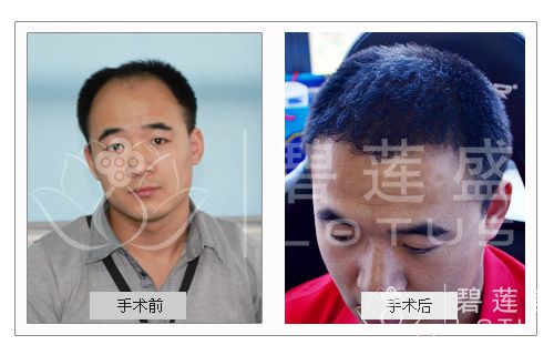 种植头发能活多久 种植头发效果怎么样 - 碧莲