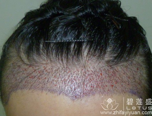 <em>女性头发少怎么办</em>,女性植发效果好不好 - 碧莲