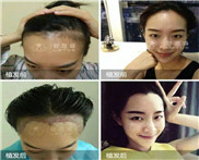 治疗斑秃有什么好方法?斑秃是不是可以自愈?