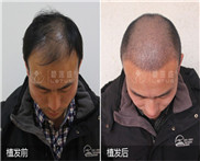 斑秃能植发改善吗?出现斑秃需不需要治疗?
