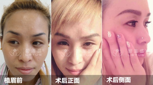 <em>白发</em>秃顶还<em>能够治好吗</em> - 碧莲盛无痕植发最好的