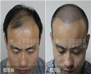 成都市哪家医院治男士秃顶精神脱发