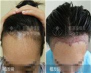北京市毛发移植哪家医院好?女性脂溢性脱发能不能改善?