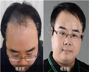 油脂性脱发用什么洗发水