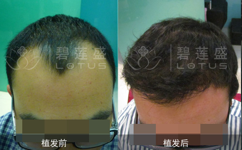 男性种植头发选择哪里的植发技术比较好