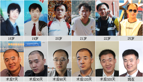 现在的植发技术会不会留下什么后遗症