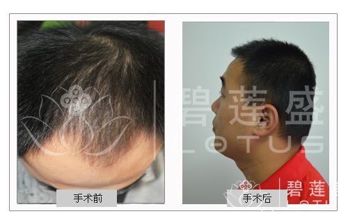 <em>种植头发能保持几年</em> <em>种植头发能保持几年</em> - 碧