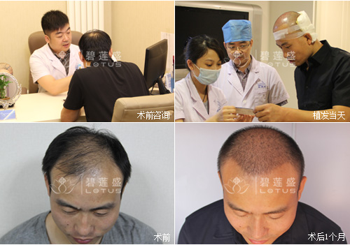 植发真的有用吗 植发每毛囊单位多少钱-碧莲盛