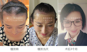 织发的效果逼真吗?还有没有比织发更好的方法